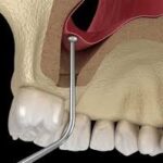 بهترین دکتر متخصص سینوس لیفت در تهران را چطور انتخاب کنیم؟