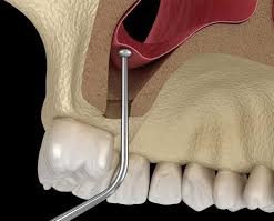 بهترین دکتر متخصص سینوس لیفت در تهران را چطور انتخاب کنیم؟
