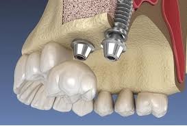 بهترین دکتر متخصص سینوس لیفت در تهران را چطور انتخاب کنیم؟2